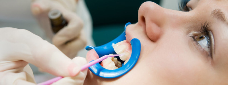 lakierowanie zębów u dzieci