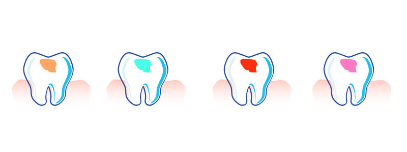Kolorowe wypełnienia zębów